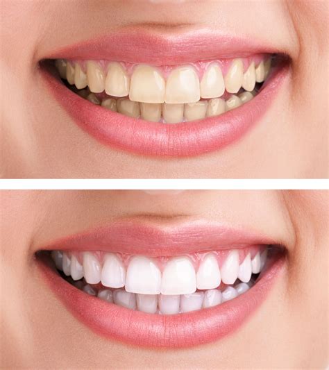 Is Masic teeth whitening suitable for everyone?